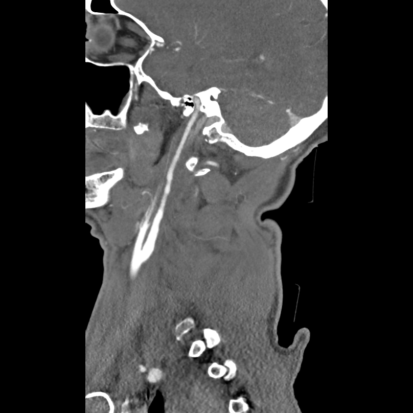 Bilateral perched facets with cord injury (Radiopaedia 45587-49713 B 8).jpg