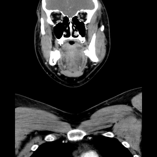File:Bilateral peritonsillar abscess (Radiopaedia 85065-100610 Coronal 25).jpg