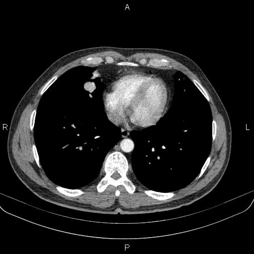 File:Bilateral pulmonary AVM (Radiopaedia 83134-97505 A 51).jpg