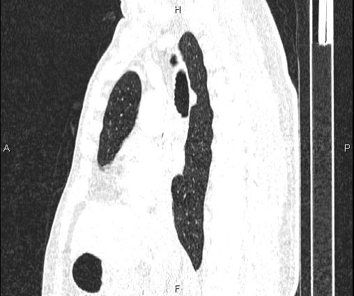 Bilateral pulmonary AVM (Radiopaedia 83134-97505 Sagittal lung window 56).jpg