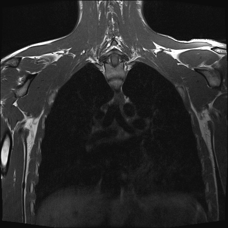 File:Bilateral spinoglenoid notch ganglion cysts (Radiopaedia 29577-30082 Coronal T1 19).jpg