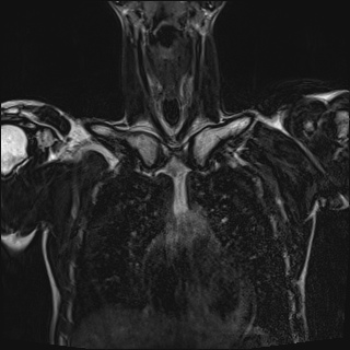 Bilateral spinoglenoid notch ganglion cysts (Radiopaedia 29577-30082 Coronal T2 34).jpg