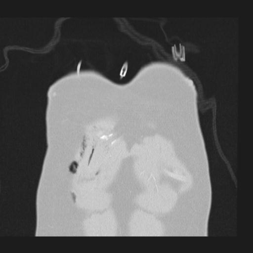 Bilateral traumatic renovascular injury (Radiopaedia 32051-32995 Coronal lung window 3).jpg