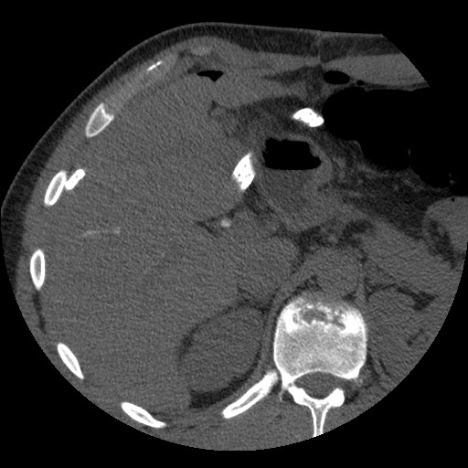 Bile leak from liver traumatic laceration (Radiopaedia 63463-72077 Axial Biliscopin 39).jpg
