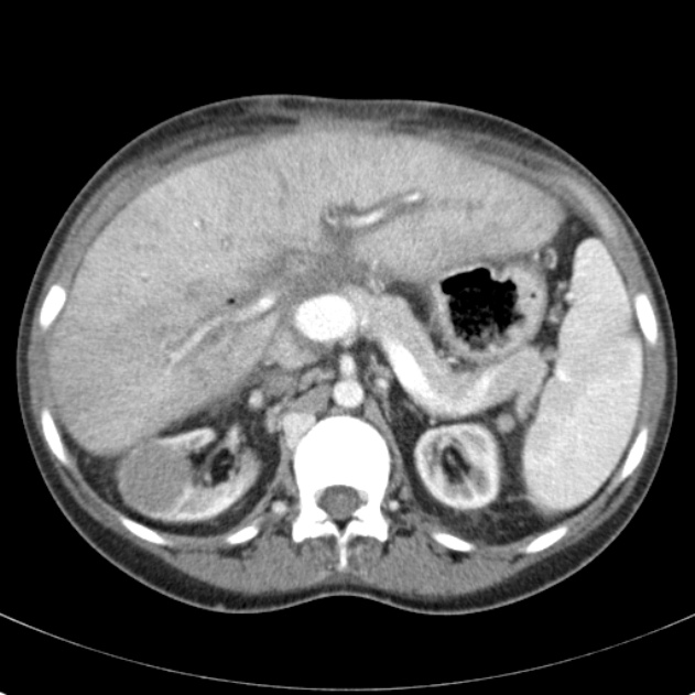 Biliary necrosis - liver transplant (Radiopaedia 21876-21846 B 25).jpg