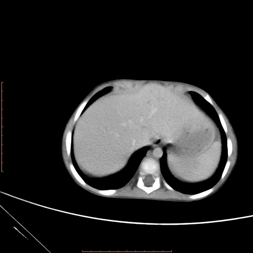 File:Biliary tract embryonal rhabdomyosarcoma (Radiopaedia 51815-57648 A 1).jpg