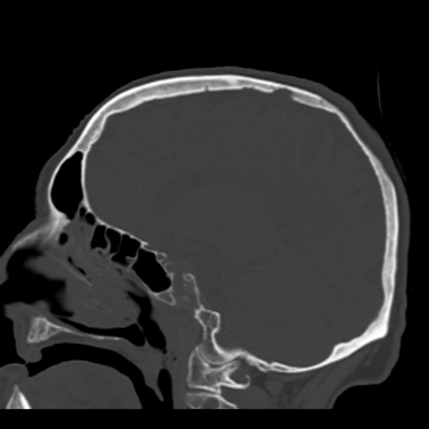 Biparietal osteodystrophy (Radiopaedia 46109-50463 Sagittal bone window 63).jpg