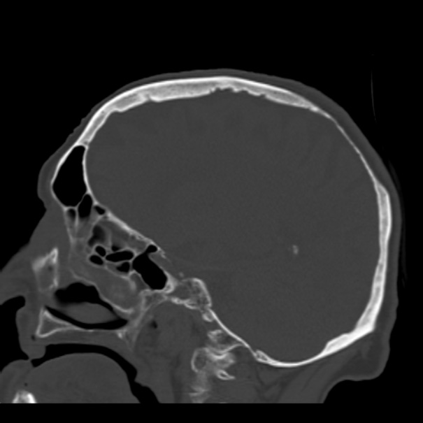 Biparietal osteodystrophy (Radiopaedia 46109-50463 Sagittal bone window 67).jpg