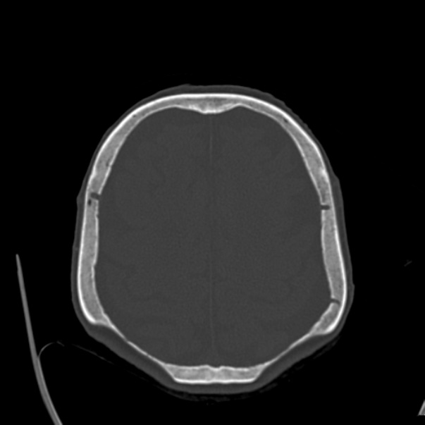 Biparietal osteodystrophy (Radiopaedia 46109-50463 bone window 49).jpg
