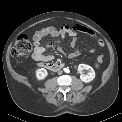 File:Bladder papillary urothelial carcinoma (Radiopaedia 48119-52951 A 27).png