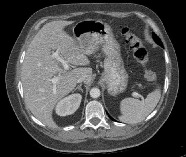 Bleeding duodenal ulcer and adenomyomatosis of gallbladder (Radiopaedia 61834-69861 A 26).jpg