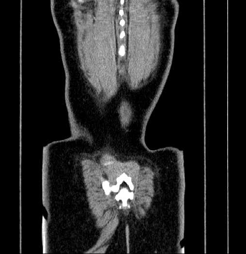Blind-ending branch of a bifid ureter (Radiopaedia 61159-69048 C 69).jpg