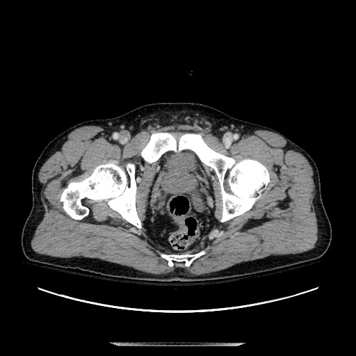 Blunt abdominal trauma with solid organ and musculoskelatal injury with active extravasation (Radiopaedia 68364-77895 A 150).jpg