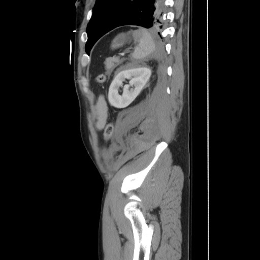 File:Blunt abdominal trauma with solid organ and musculoskelatal injury with active extravasation (Radiopaedia 68364-77895 C 115).jpg