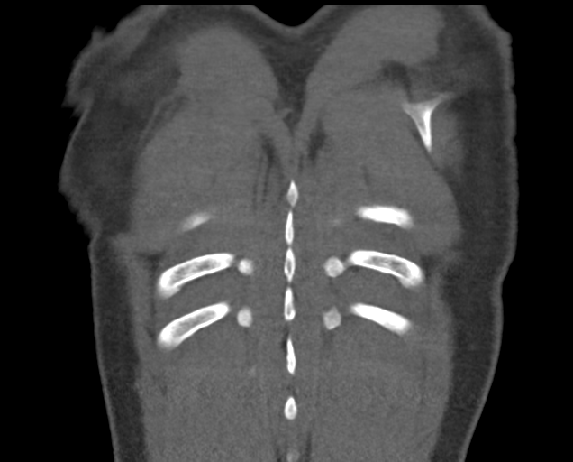 Boerhaave syndrome (Radiopaedia 39382-41660 C 84).png