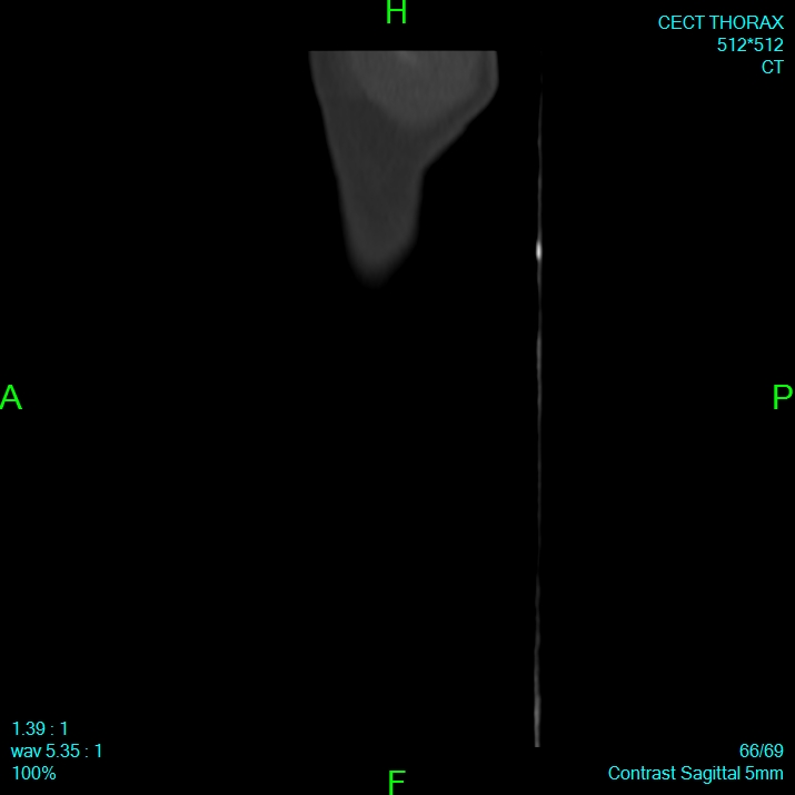 Bone metastases from lung carcinoma (Radiopaedia 54703-60937 Sagittal bone window 66).jpg