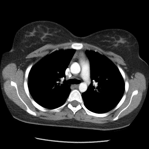 File:Borderline mucinous tumor (ovary) (Radiopaedia 78228-90808 A 18).jpg
