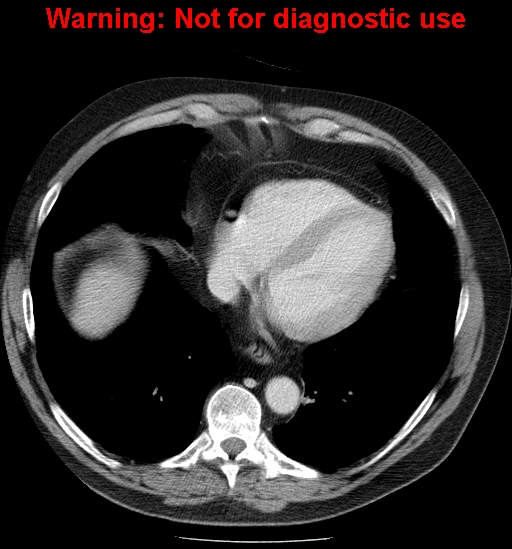 File:Bosniak renal cyst - type IV (Radiopaedia 23402-23466 D 2).jpg