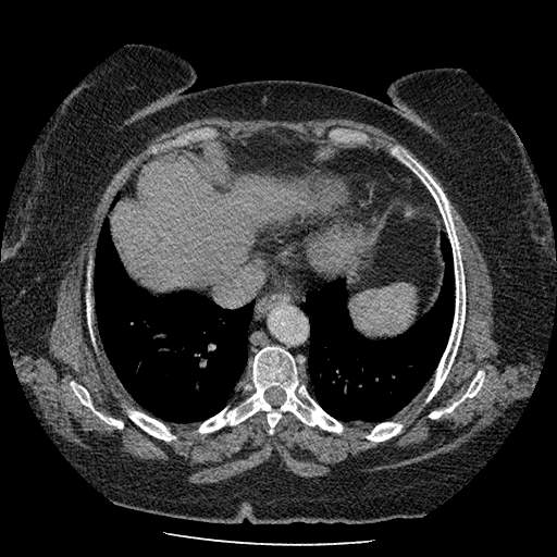 Bovine aortic arch - right internal mammary vein drains into the superior vena cava (Radiopaedia 63296-71875 A 118).jpg