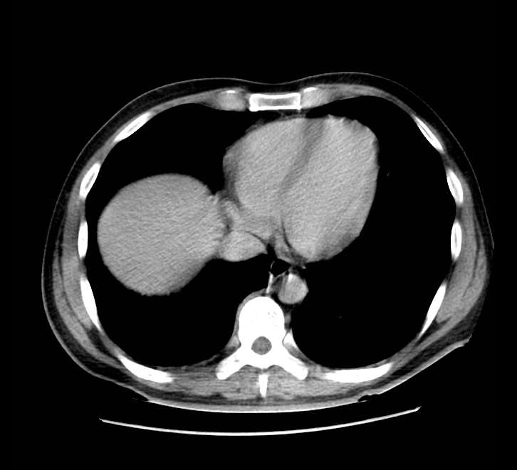 Bowel obstruction from colon carcinoma (Radiopaedia 22995-23028 A 5).jpg