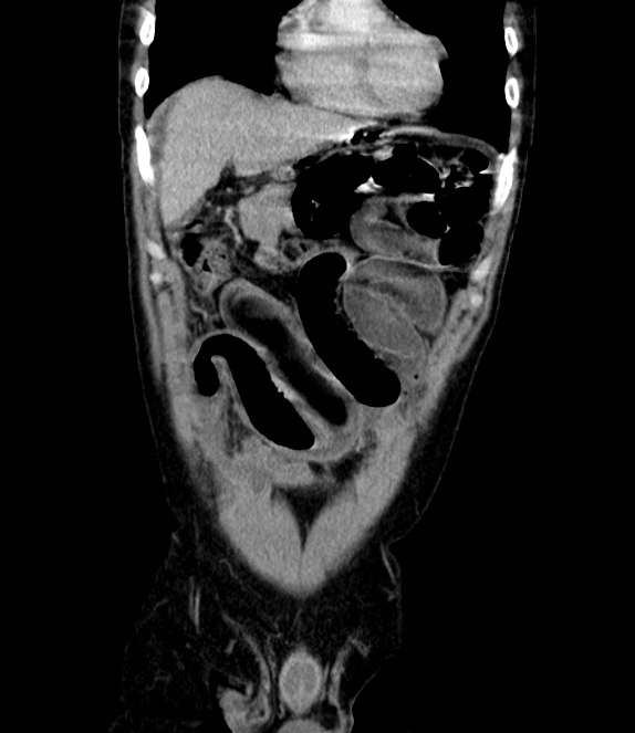 Bowel obstruction from colon carcinoma (Radiopaedia 22995-23028 C 15).jpg
