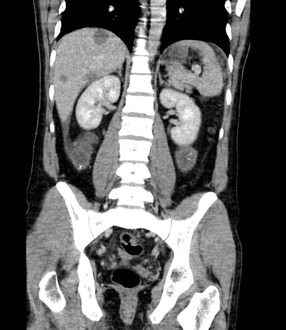 Bowel obstruction from colon carcinoma (Radiopaedia 22995-23028 C 50).jpg