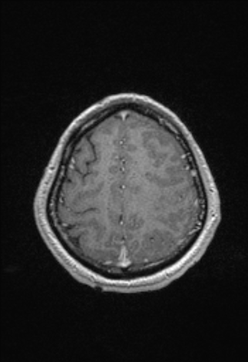Brain abscess with ventriculitis (Radiopaedia 85703-101495 Axial T1 C+ 141).jpg