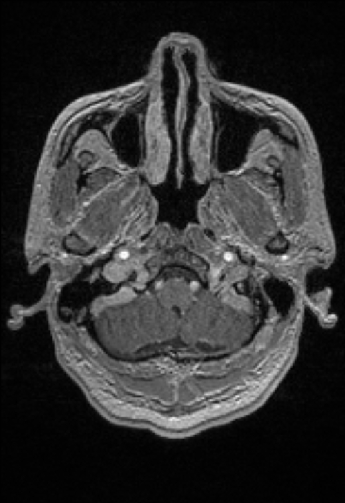 Brain abscess with ventriculitis (Radiopaedia 85703-101495 Axial T1 C+ 29).jpg