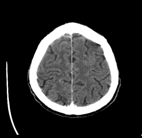 File:Brain metastases from lung cancer (Radiopaedia 24480-24781 Axial C+ delayed 52).jpg
