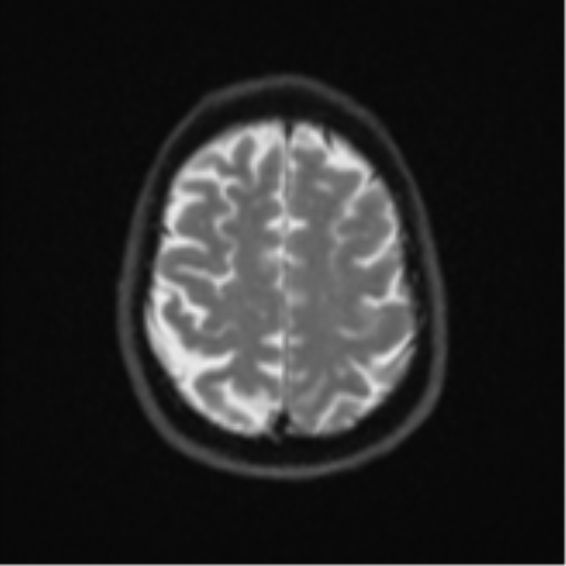 File:Brain metastasis (large cystic mass) (Radiopaedia 47497-52107 Axial DWI 22).png