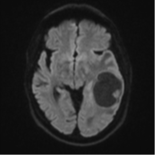 Brain metastasis (large cystic mass) (Radiopaedia 47497-52107 Axial DWI 40).png
