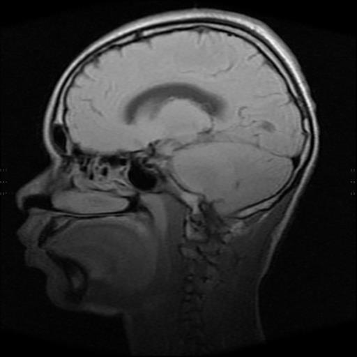 File:Brainstem glioma (Radiopaedia 30923-31624 Sagittal T1 11).jpg