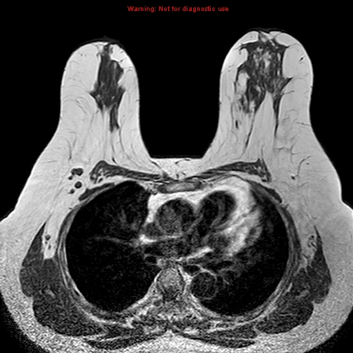 File:Breast carcinoma (multicentric multifocal in mammary Paget disease) (Radiopaedia 50966-56512 Axial T1 11).jpg