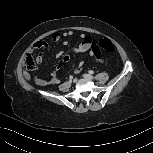File:Breast carcinoma with pathological hip fracture (Radiopaedia 60314-67974 B 48).jpg