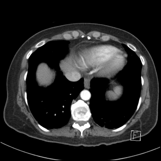 Breast metastases from renal cell cancer (Radiopaedia 79220-92225 A 72).jpg