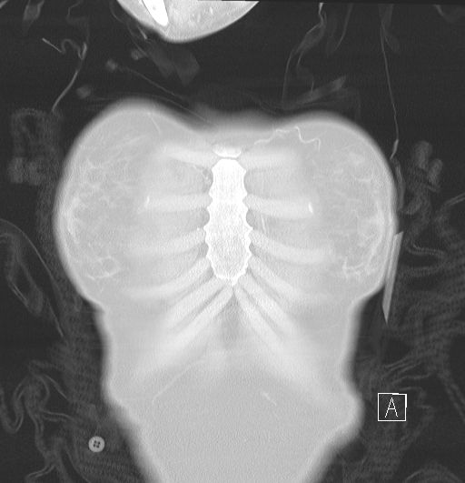 File:Bronchial atresia (Radiopaedia 73677-84470 Coronal lung window 2).jpg