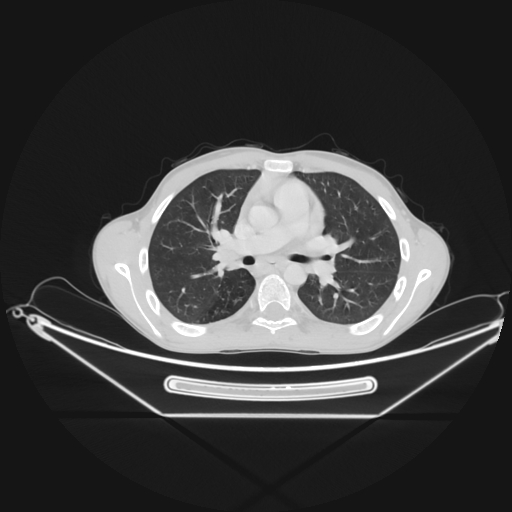 Bronchial carcinoid tumor (Radiopaedia 57187-64090 Axial lung window 32).jpg