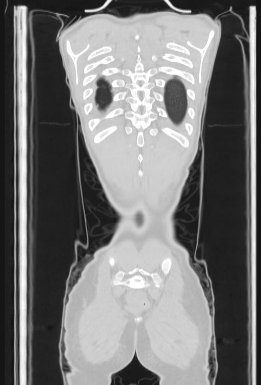 Bronchial carcinoid tumor (Radiopaedia 57187-64090 Coronal lung window 103).jpg