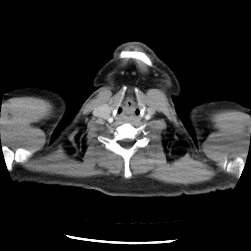 Bronchial carcinoid tumor (Radiopaedia 67377-76764 A 1).jpg