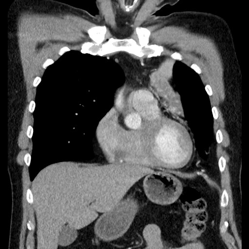Bronchial carcinoid tumor (Radiopaedia 67377-76764 C 26).jpg