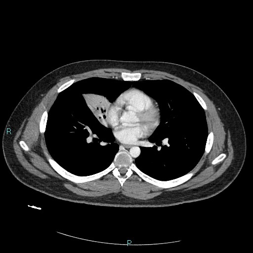 Bronchial carcinoid tumor (Radiopaedia 78272-90875 A 55).jpg