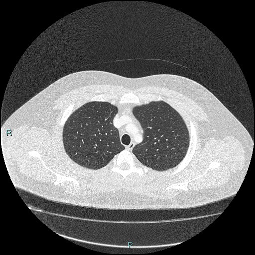 Bronchial carcinoid tumor (Radiopaedia 78272-90875 Axial lung window 10).jpg