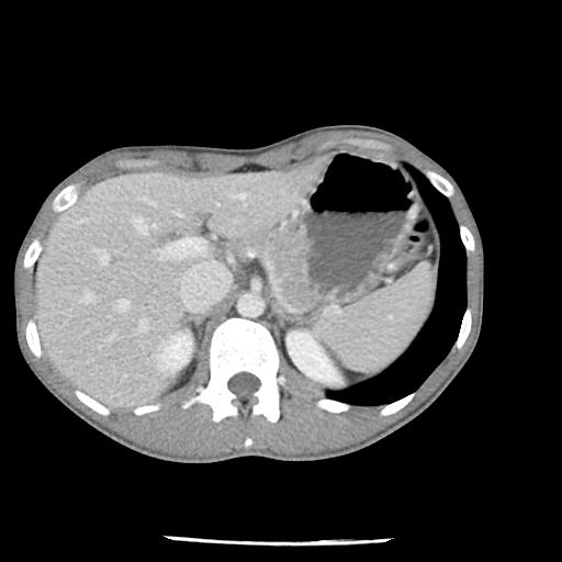 Bronchial carcinoid tumor causing right lower lobe collapse (Radiopaedia 83495-98594 A 54).jpg