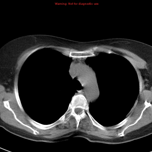 File:Bronchoalveolar carcinoma (BAC) (Radiopaedia 13436-13392 Axial non-contrast 16).jpg