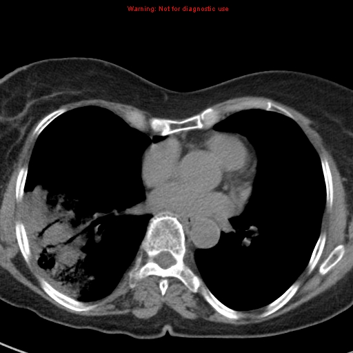 File:Bronchoalveolar carcinoma (BAC) (Radiopaedia 13436-13392 Axial non-contrast 31).jpg
