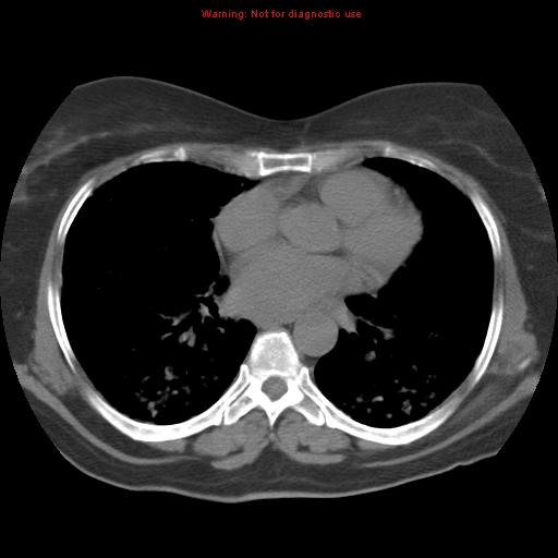 Bronchoalveolar carcinoma (Radiopaedia 13224-13233 Axial non-contrast 27).jpg