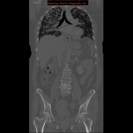 File:Bronchoalveolar carcinoma (Radiopaedia 13224-13233 Coronal non-contrast 11).jpg