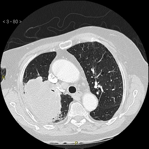 File:Bronchogenic carcinoma as an incidental finding (Radiopaedia 16453-16130 Axial lung window 80).jpg