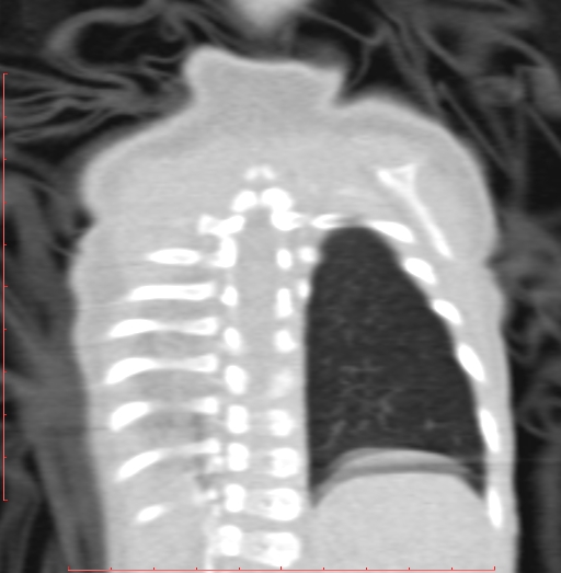 Bronchogenic cyst (Radiopaedia 78599-91409 Coronal lung window 190).jpg