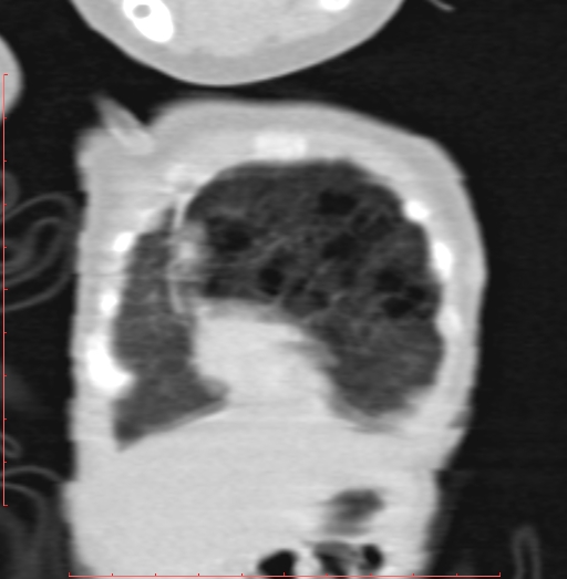 File:Bronchogenic cyst (Radiopaedia 78599-91409 Coronal lung window 34).jpg